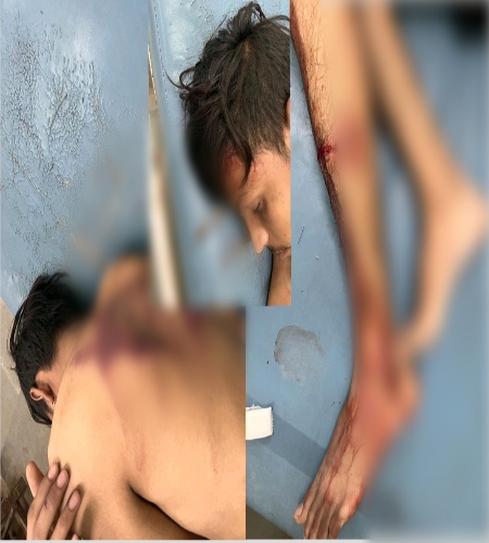 बिलासपुर/ सरकंडा क्षेत्र में सरेराह युवको की बेरहमी से पिटाई,,रेहान के सर ,पीठ और पैर में किया गया वार,,,video