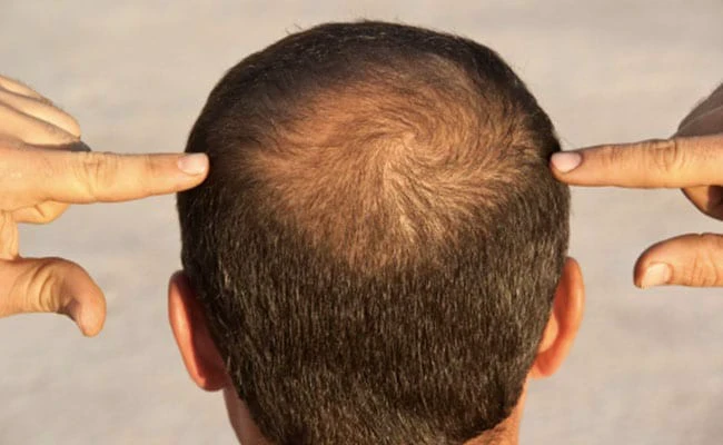  सिर्फ 30 दिन&hellip; सरसों के तेल में मिलाइए ये जादुई चीज़, गंजे सिर पर भी उग आएंगे नए बाल &ndash; लोग कहेंगे जुल्फी जुल्फी!